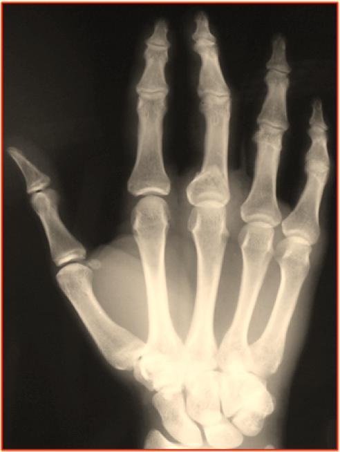 Of the 6 cases with a diaphyseal fracture, 2 showed only a rotation deformity, 2 cases rotation and volar angulation and 2 cases only a shortening deformity, with a bony spike that limited PIP joint
