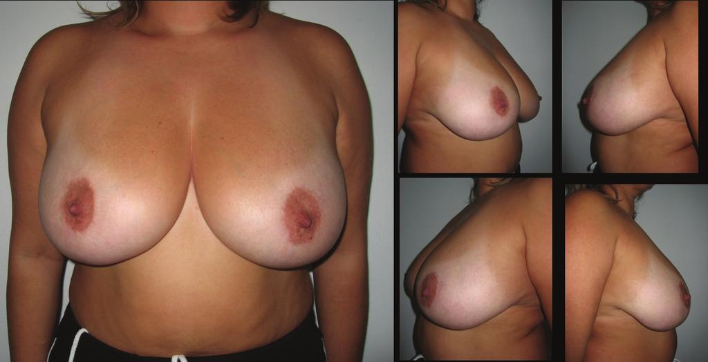 114 Snowman pattern reduction mastopexy Fig. 5: Patient-9; 35-year-old women preoperative breast views. Fig. 6: Eighteen months postoperative results of patient-9.