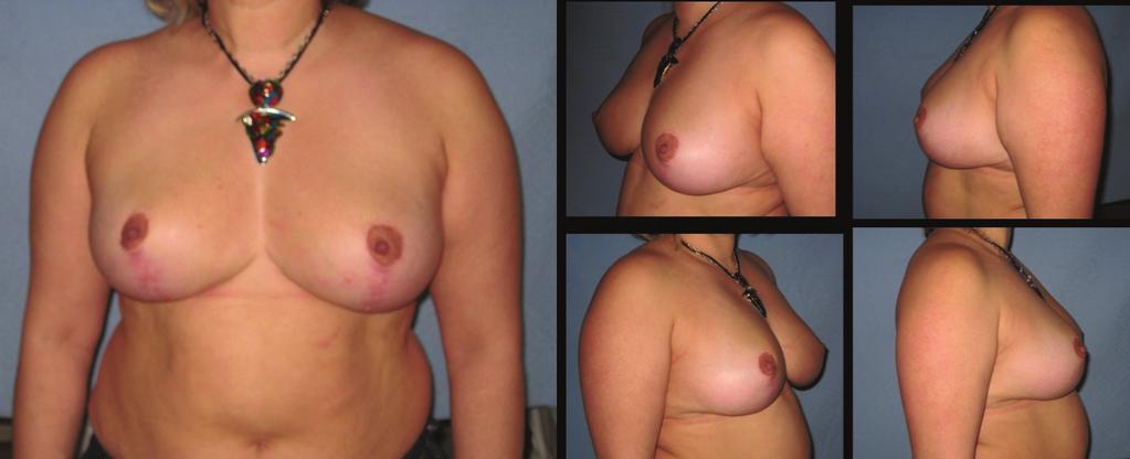 Patients may request the surgeons to surgically lift their breasts and increase projection rather than reduce them.