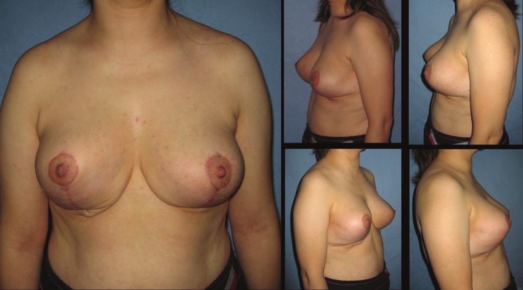 116 Snowman pattern reduction mastopexy Fig. 9: Patient 20; 33-year-old women preoperative breast views. Fig. 10: Twenty two months postoperative results of patient-20.
