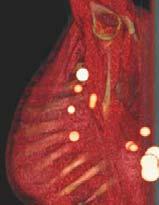 areas of deep lymphatic drainage (pelvis, abdomen, or mediastinum)