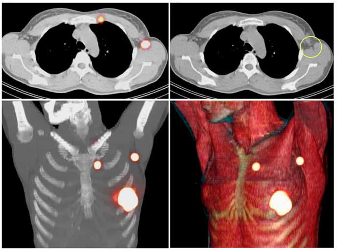 SPECT/CT: Added Values Pre-surgical imaging Breast