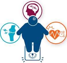 OBESITY Overweight and obesity are defined as abnormal or excessive fat accumulation that causes several health problems