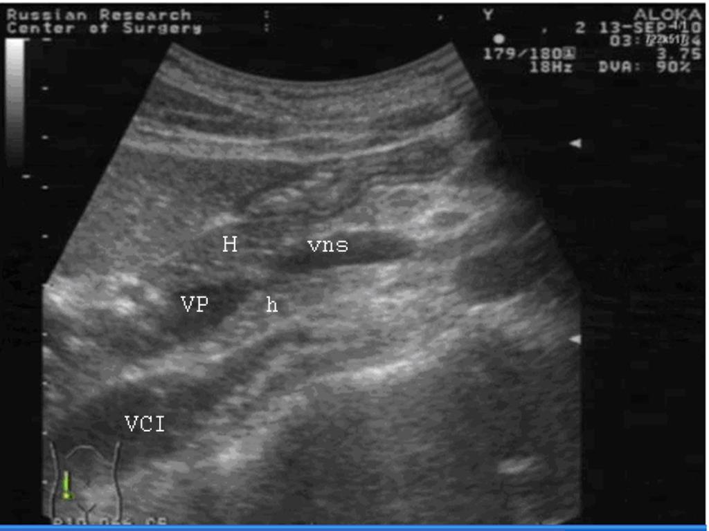 Fig. 1: normal ultrasound anatomy of the pancreas head (H). Longitudinal section.