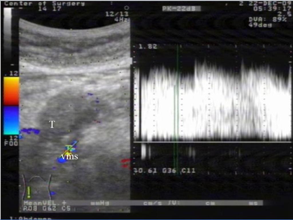 Fig. 2: compression of superior mesenteric vein (vms) by the cancer (T) of pancreatic head (P) without invasion - monophasic blood flow.