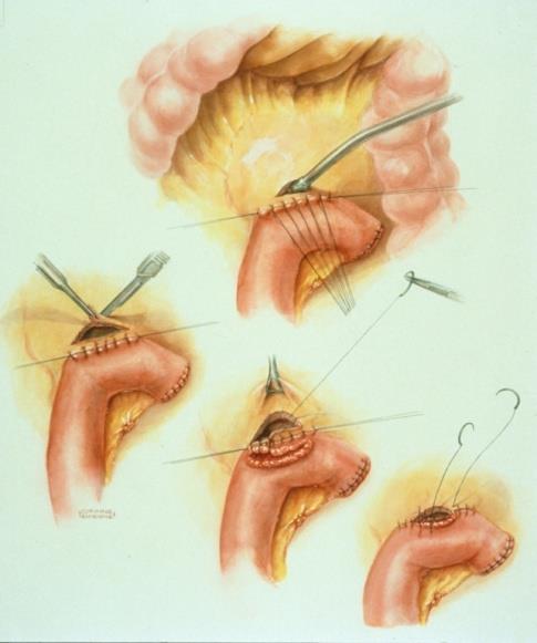 Operative Therapy Cystgastrostomy for cysts adhered to