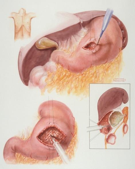 and uncinate process of pancreas Cystjejunostomy via