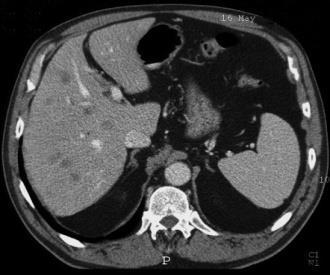 CT Resectability-Classification Metastatic evidence of metastatic spread