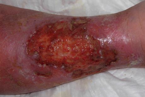 Chronic Wounds: Stuck Where does it get stuck?