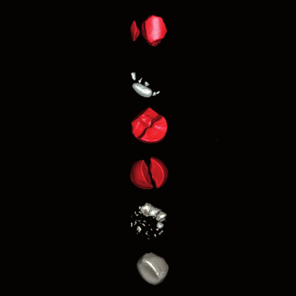 stone containing both uric acid and calcium compounds; uric acid marked in red, calcium compounds in white Figure 2.