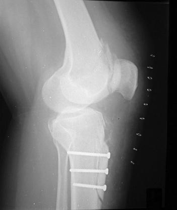 208 CASE STUDY 11 CHRONIC PATELLAR DISLOCATION IN ADULTS posteriorly on the tibia and the patella runs deeper into the trochlear groove.
