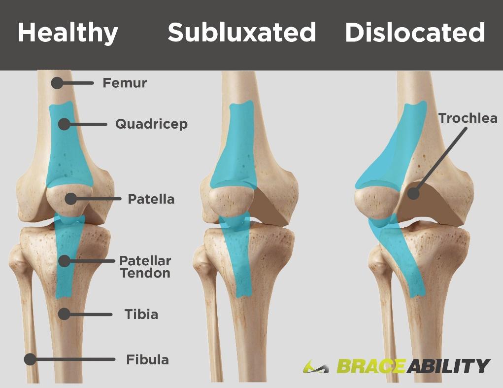 either side of the patella, play an enormous role in maintaining proper knee stability (Kaar).