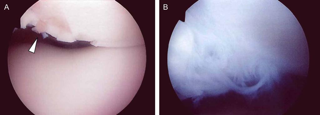 Osteoarthritis and Cartilage Vol. 13, No.