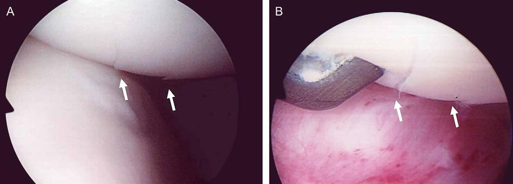 1032 E. Nomura and M. Inoue: Second-look arthroscopy of cartilage changes of the patellofemoral joint Fig. 4. A 23-year-old female of APD.