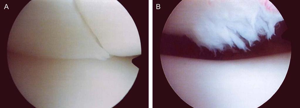 Osteoarthritis and Cartilage Vol. 13, No. 11 1033 Fig. 6. A 21-year-old female of APD. A: At the first arthroscopy, two large and deep cracks were on the central dome.