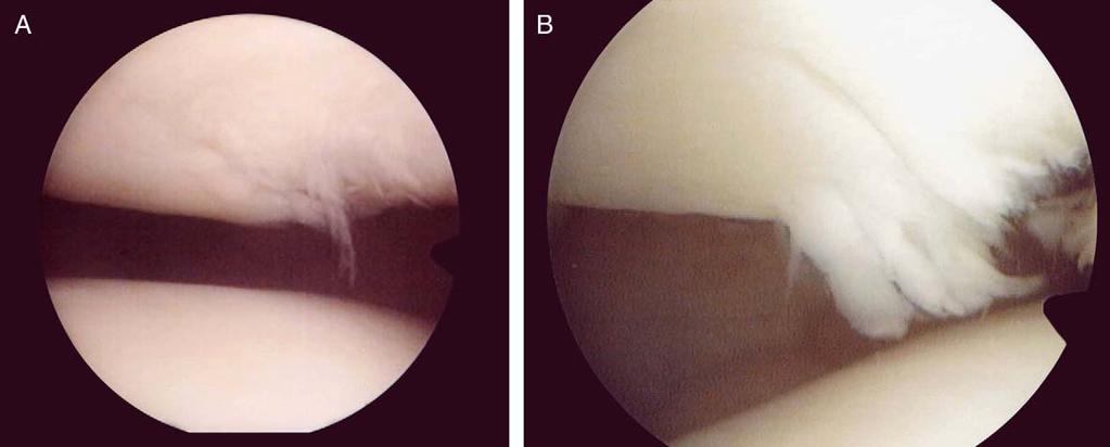 At the first arthroscopy, fibrillation was seen on the medial facet and central dome. B: A second-look arthroscopy was performed 14 months after first arthroscopy. Fibrillation did not change.