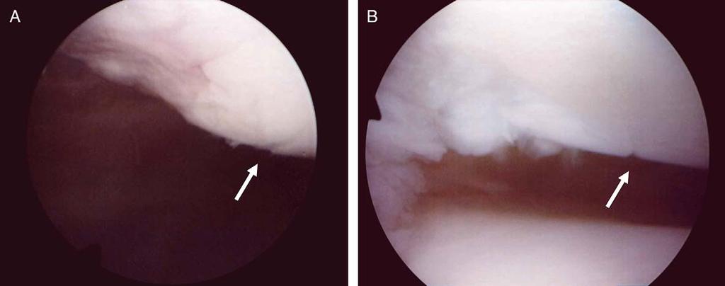 Osteoarthritis and Cartilage Vol. 13, No. 11 1035 Fig. 9. A 14-year-old girl of RPD.