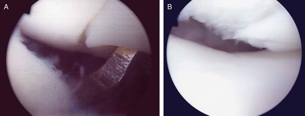 1036 E. Nomura and M. Inoue: Second-look arthroscopy of cartilage changes of the patellofemoral joint Fig. 11. A 23-year-old female of RPD.