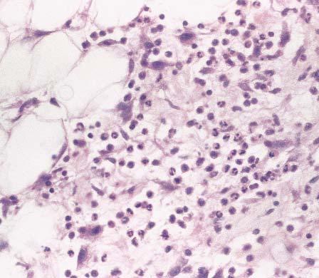 Demirkesen et al / NODULAR CUTANEOUS LESIONS OF BEHÇET SYNDROME Image 1 Behçet syndrome. Neutrophil-predominating cell infiltrate in subcutis (H&E, 400).