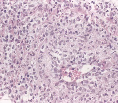 Anatomic Pathology / ORIGINAL ARTICLE Image 5 Neutrophilic vasculitis in a small artery in Behçet syndrome (H&E, 400).