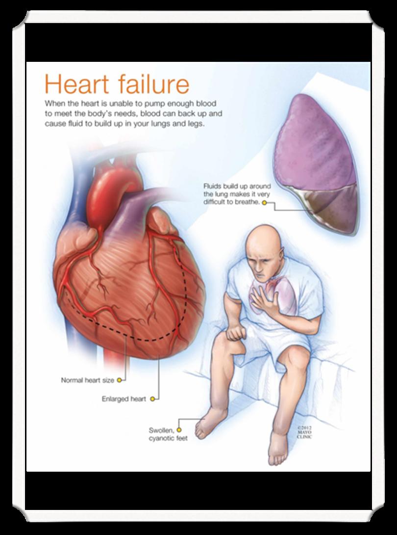 Left sided Heart Failure Systolic failure: loss of ability to squeeze.