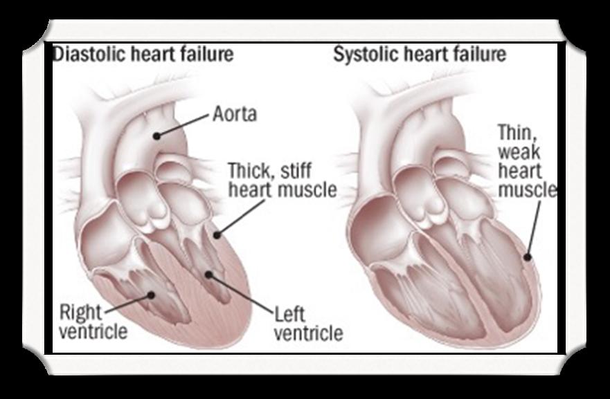 Diastolic failure: loss of ability to relax. This prevents adequate blood filling into the LV.
