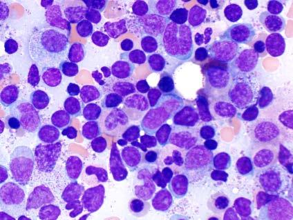 prolymphocytic leukemia