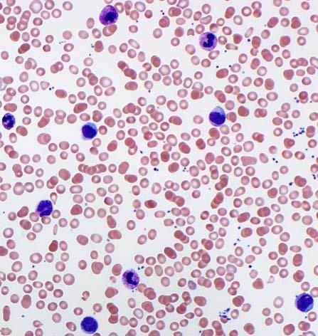 Granulocyte colony stimulating factor Peripheral Blood Bone marrow core