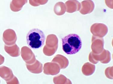 Dohle bodies also Cytologic changes typically abate after removal of the offending agent Be