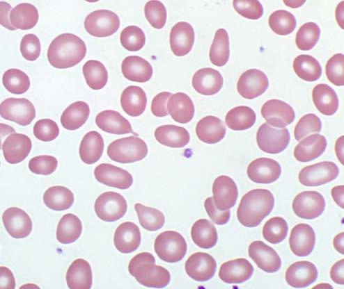 Peripheral Blood findings Macrocytic anemia Pancytopenia in severe cases