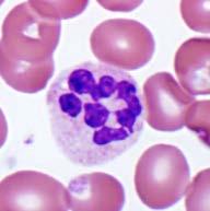 severity of the deficiency often includes schistocytes Hypersegmented