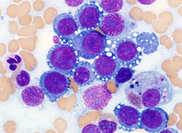 Megaloblastic anemia may mimic Pure erythroid leukemia Myeloid