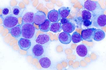 lymphoma, carcinoma Key tips in megaloblastic anemia: Be careful