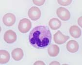 macrocytic, or microcytic anemia minimal