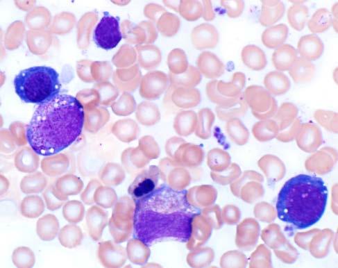 Bone marrow findings Variable cellularity May be hypocellular, normocellular, or hypercellular Possible erythroid predominance Cytologic Distinctive cytoplasmic vacuoles in granulocytic and erythroid