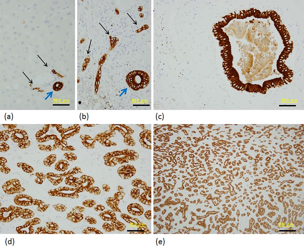 Figure 1. Comparison of non-neoplastic small bile ducts and CoCC (immunohistochemistry for CK7). The thin black arrows in (a) and (b) show cholangioles.