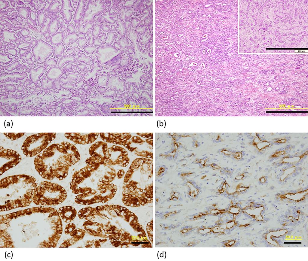 Figure 2. Comparison of ICC and CoCC based on the microscopic findings. (a) and (b) show Hematoxylin and Eosin staining for ICC and CoCC. Bar: 500 μm.