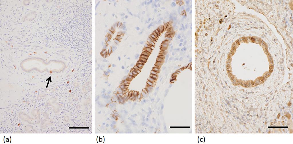 Figure 5. Immunohistochemistry for stem/progenitor cell markers in the non-neoplastic small bile ducts. (a) c-kit is positive in the cell of a septal duct. Bar: 200 μm.