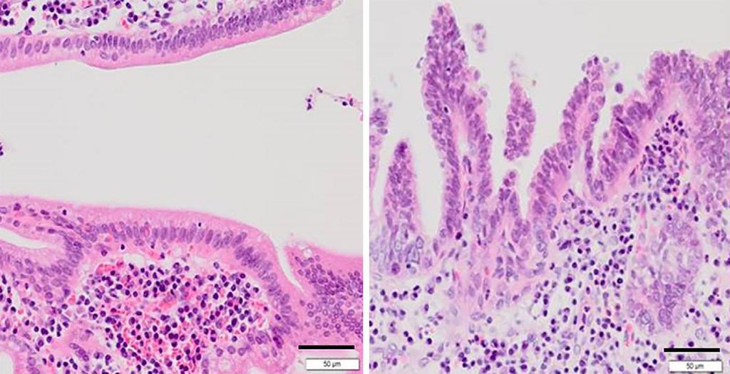 Figure 9. Histological features of the non-neoplastic and carcinoma areas of the hepatic hilus. The tumor cells appeared to be slightly smaller than the non-tumor cells. Bar: 50 μm Figure 10.
