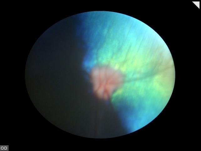 Fundoscopy reveled shrinking of the lood vessels, decresed pigmenttion of the non-tpetl fundus, incresed reflection from the tpetum nd trophied optic disc with sclloped orders.