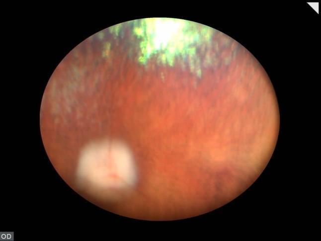 122 Irnin Journl of Veterinry Reserch, Shirz University Fig. 4: An dvnced cse of retinl degenertion ( nd ). The tpetl fundus is hyperreflective, nd only ghost vessels re visile Fig.