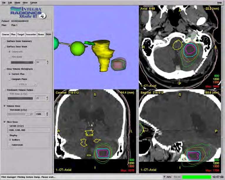 436 Diagnostic Techniques and Surgical Management of Brain Tumors Fig. 2.