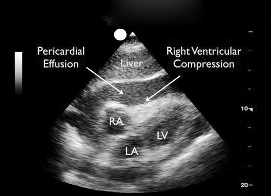 Figure 1: Acute pericardial tamponade diastolic collapse of the right ventricle is noted on subxiphoid view.