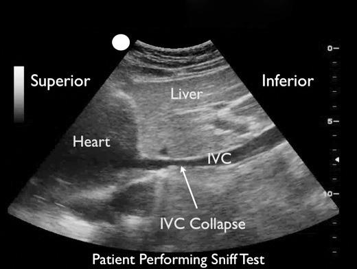 The presence of a dilated inferior vena cava with less than 50% collapse on forced inspiration, or sniff, correlates with an elevated central venous pressure and confirms tamponade physiology Figure