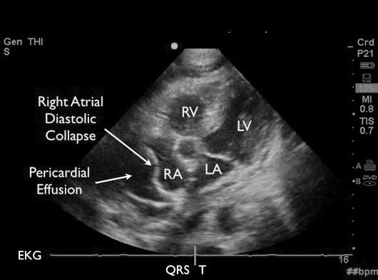 RV, right ventricle; RA, right atrium; LV, left ventricle; LA, left atrium circumferential pericardial effusion with depressed left ventricular function.