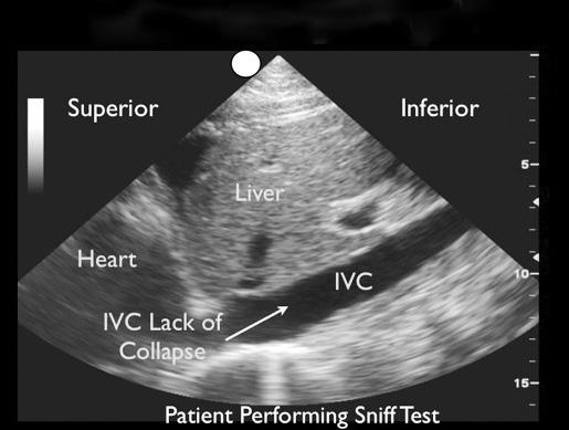 The IVC is small in diameter, with normal respiratory variation [Figure 4].