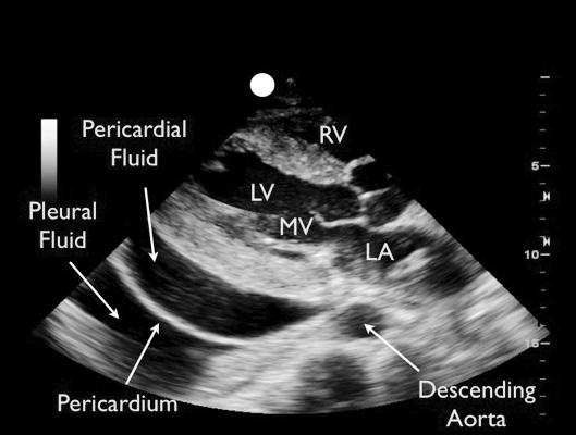 Note the descending aorta seen as a cylinder posterior to the left atrium. The posterior pericardial reflection is located anterior to the aorta.