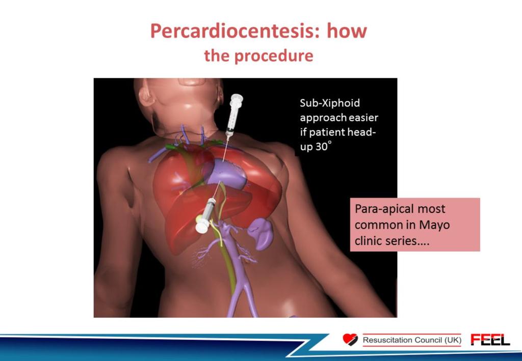 This diagram shows the two main approaches for drainage of a pericardial collection.