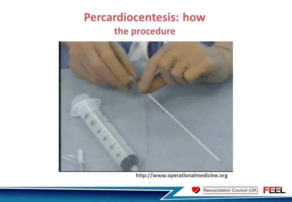 This is a short video outlining the steps involved in pericardiocentesis ECG monitoring will usually be in place (and should be used if possible, as excessive new ventricular ectopy may signify