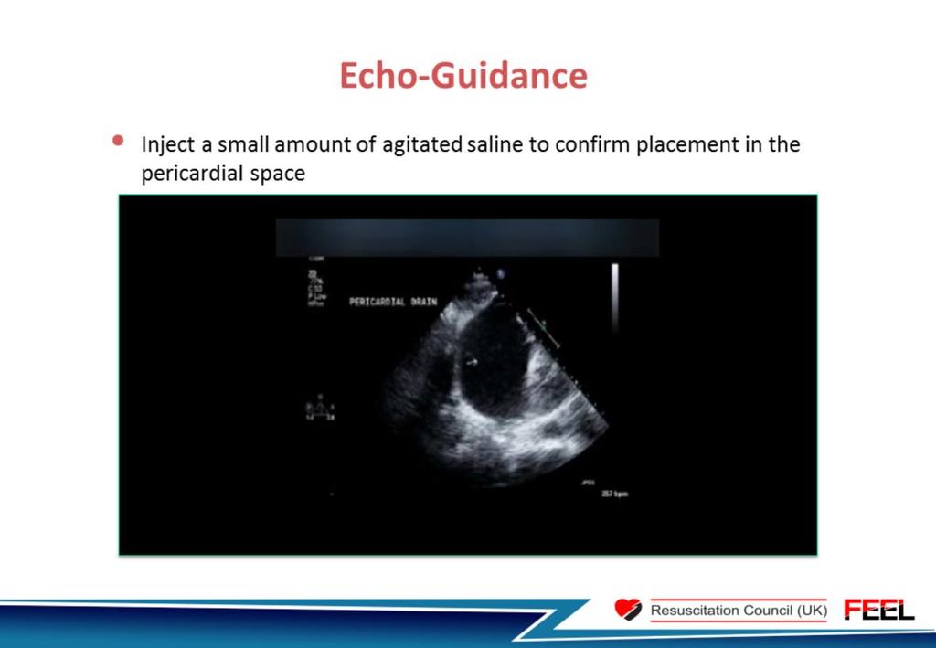 Step 4 once blood/fluid is drawn back, injection of a small amount of agitated saline can be useful to confirm correct placement in the pericardial space (as opposed to a cardiac chamber particularly